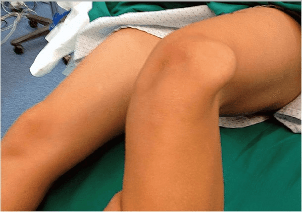 Luxația de rotulă unnamed 37